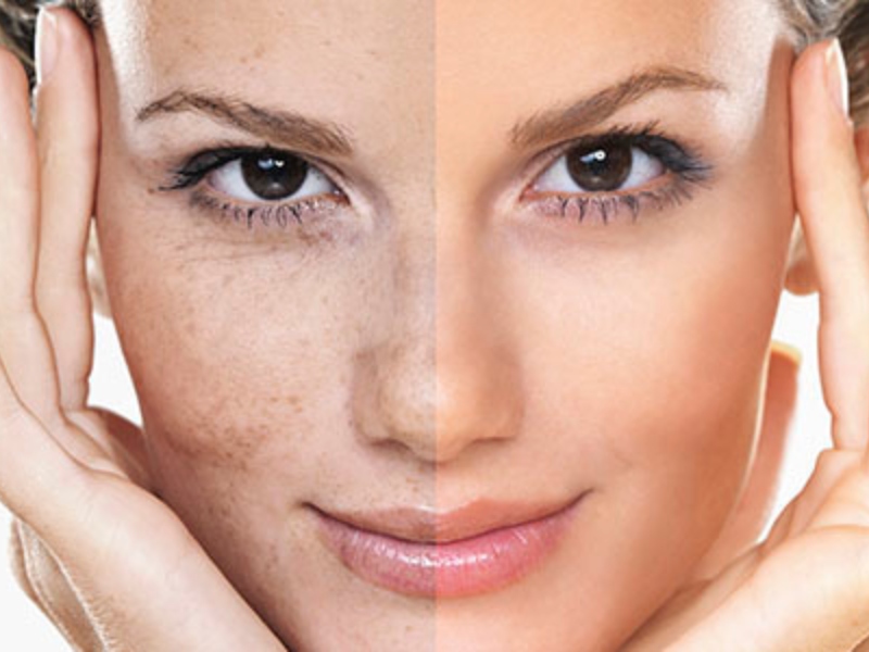 5-secret-solutions-to-manage-uneven-skin-tone